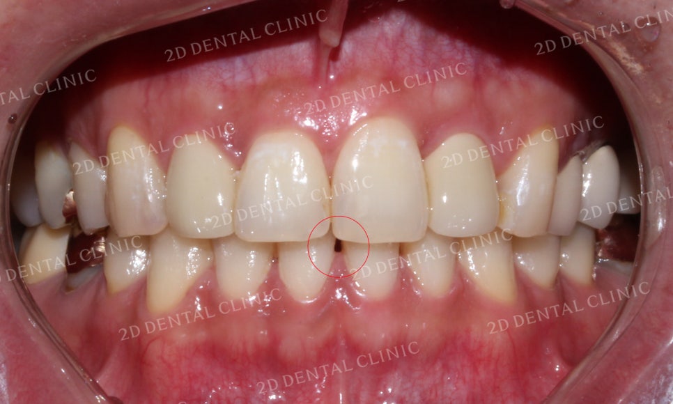 [2D교정] 나비치아교정을 2D교정 장치로 빠르게 완성하기! by.2D치과(투디치과) 관련 이미지 14