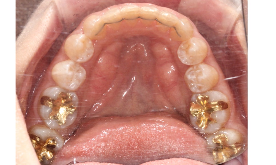 양악교정 송곳니교정 중심으로 관련 이미지 15