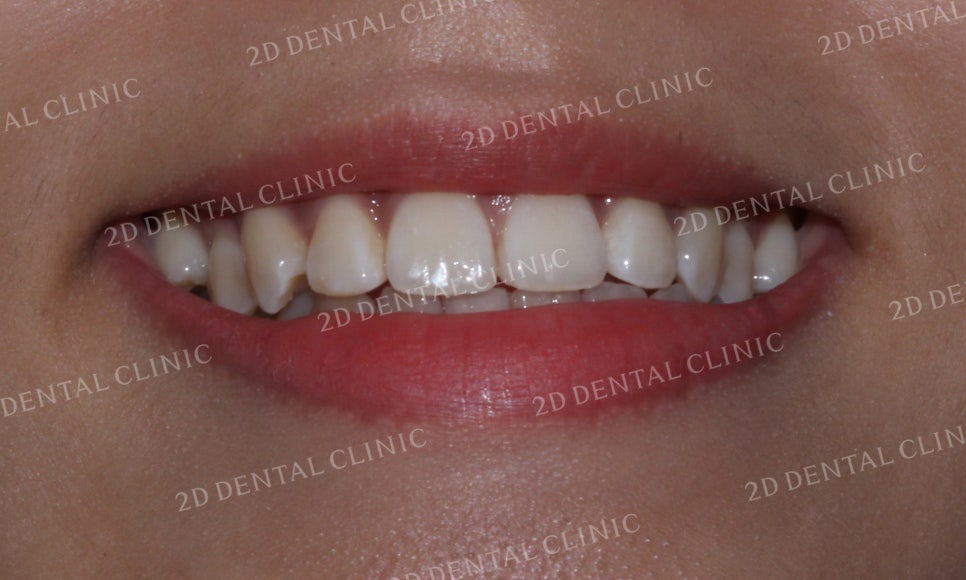 토끼앞니, 튀어나온 앞니 부분교정 후기! by.투디치과(2D치과) 관련 이미지 9
