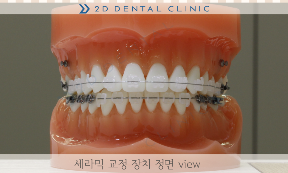 [교정상식] 치아교정, 그것이 알고싶다! 관련 이미지 3