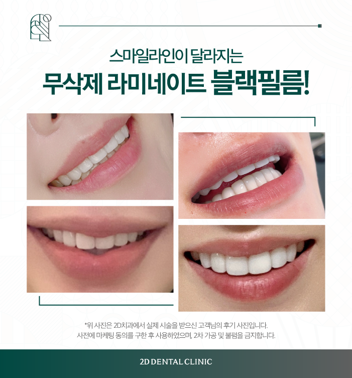 치아 무삭제 라미네이트 블랙필름 효과, 만족도는? 관련 이미지 7