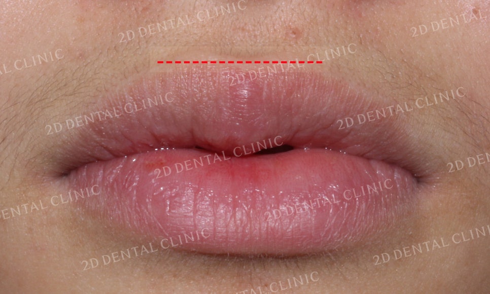 반대교합 치아교정, 앞니를 가지런하게! by.투디치과(2D치과) 관련 이미지 8