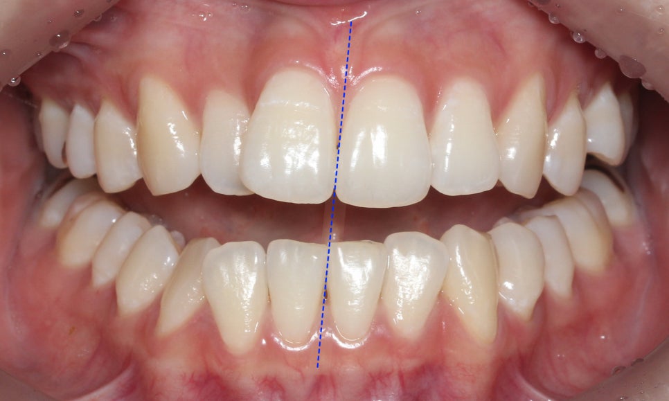 신논현치과 자가결찰브라켓 장점 관련 이미지 2