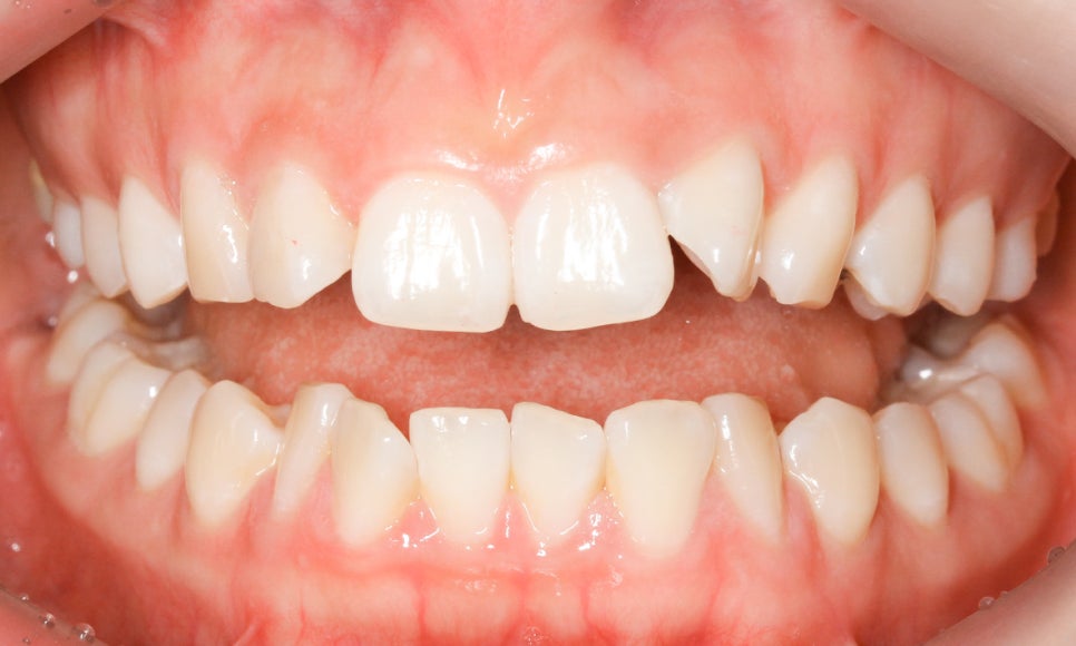 세라믹교정 앞니틀어짐 교정 사례 관련 이미지 2