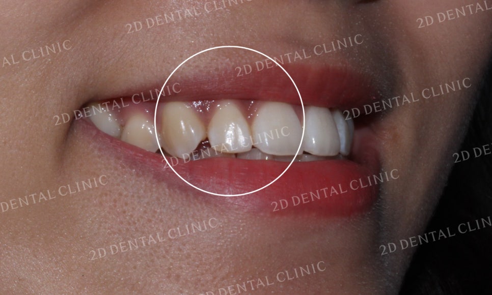 토끼앞니, 튀어나온 앞니 부분교정 후기! by.투디치과(2D치과) 관련 이미지 11