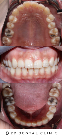 돌출입 유형 및 증상, 치과 내원 전 자가진단! 관련 이미지 8