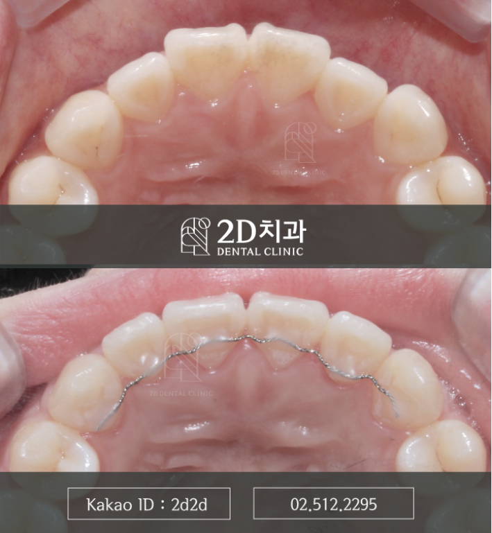 강남라미네이트 앞니변색 치아콤플렉스 개선은 블랙필름 관련 이미지 7