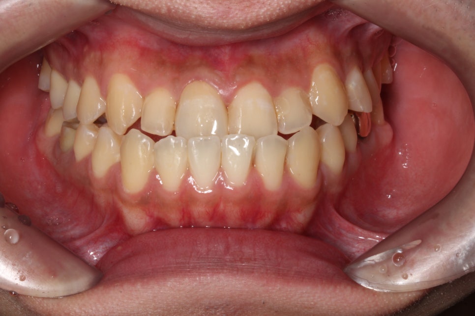 2D(투디)치과 블링스, 추천합니다!(깨진 앞니, 돌출앞니, 벌어진 앞니, 치아 노후, 치아 변색) 관련 이미지 5