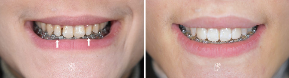 무삭제블랙필름 실제 후기 관련 이미지 7