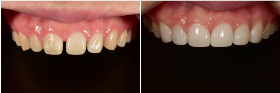앞니라미네이트 잘하는 곳 : 2D치과 관련 이미지 6