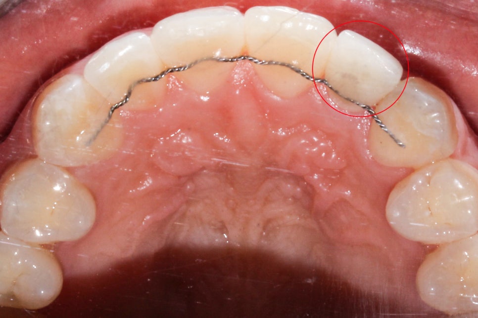 왜소치 뻐드렁니 교정 신논현역치과에서 관련 이미지 13
