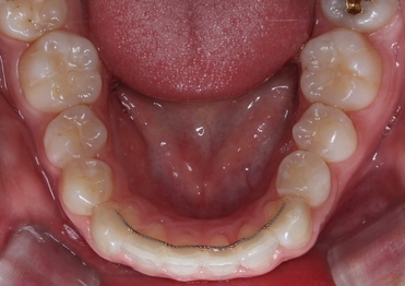 투명교정. 그것이 알고싶다! 관련 이미지 4
