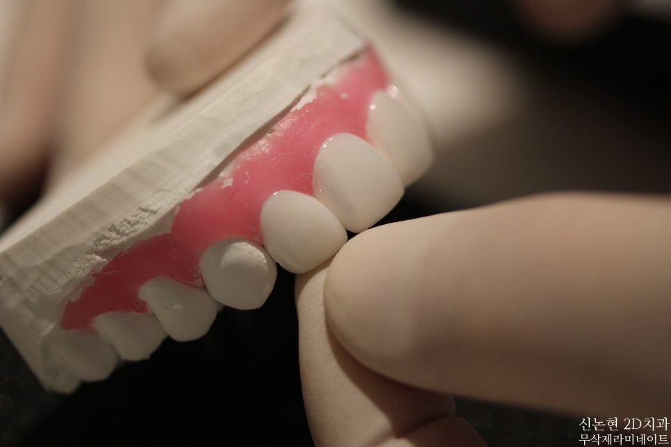 강남라미네이트치과 추천 : 진짜 무삭제, 투디치과! 관련 이미지 3