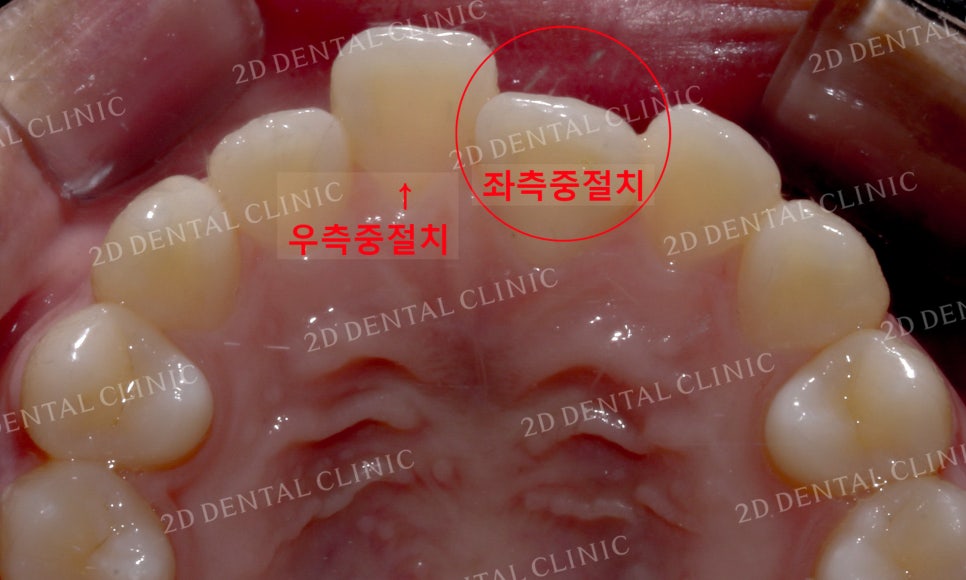 반대교합 치아교정, 앞니를 가지런하게! by.투디치과(2D치과) 관련 이미지 6