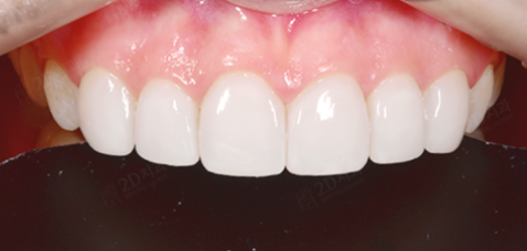 치아삭제 없는 블랙필름 무삭제라미네이트가격 관련 이미지 8