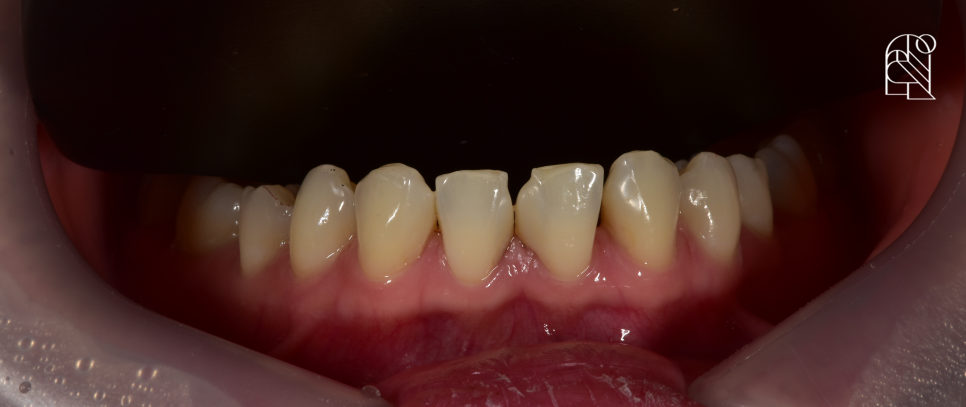 앞니깨짐 (앞니파절) 치료방법 세 가지 - 레진, 라미네이트, 크라운 관련 이미지 5