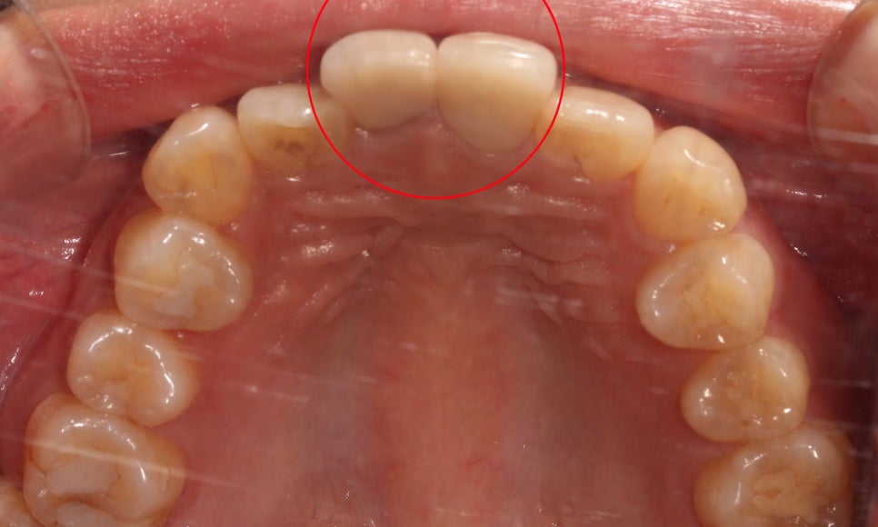 토끼앞니교정, PFM크라운 재보철을 동시에 치료하는 방법? 관련 이미지 6