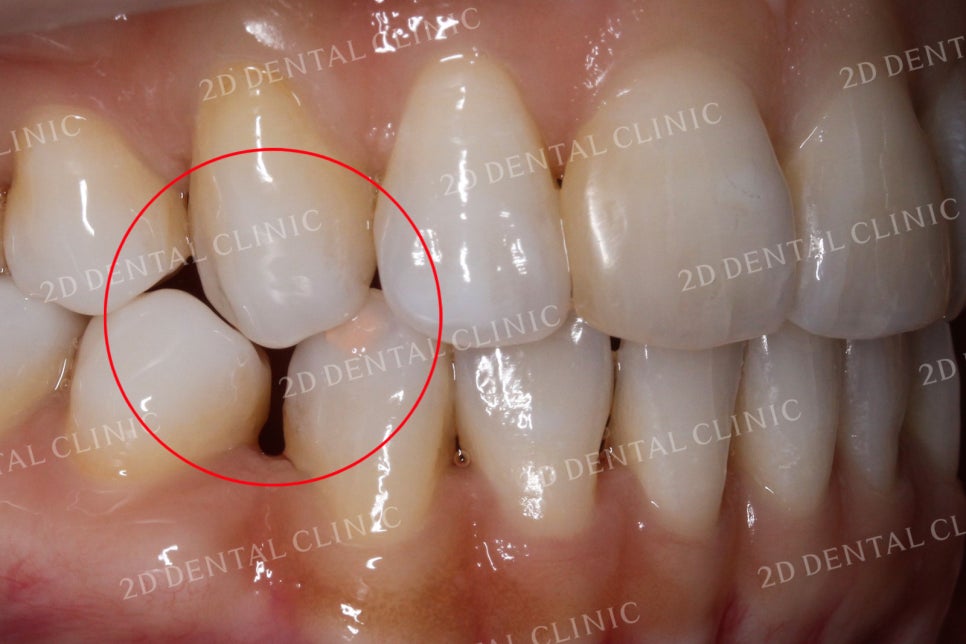 치아틈새를 완벽하게 메꾸자! 블랙트라이앵글 쎄라필름으로 완전 삭제! by.투디치과(2D치과) 관련 이미지 15