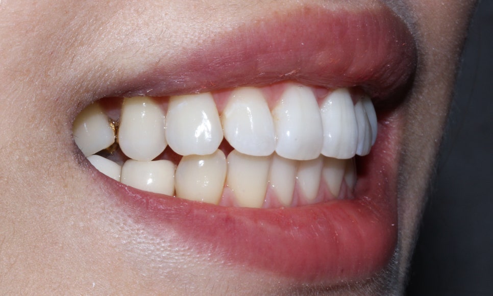 토끼 이빨 치아교정 5개월 교정 완료! by. 투디치과(2D치과) 관련 이미지 7