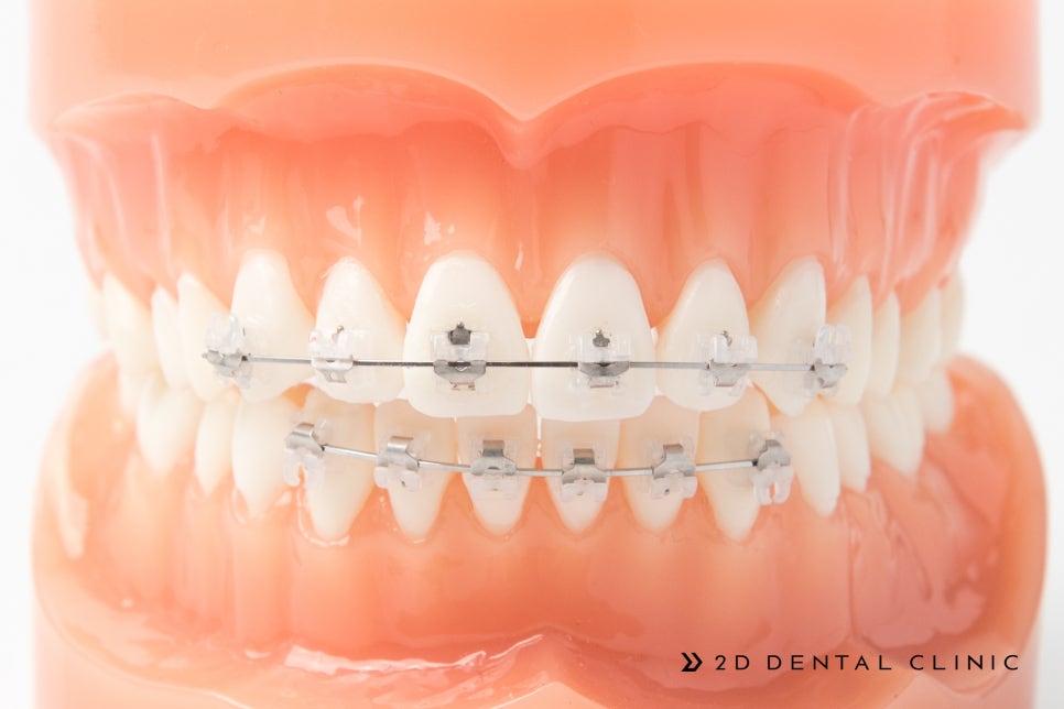방학기간 동안 대학생을 위한 앞니 부분교정 종류 관련 이미지 1