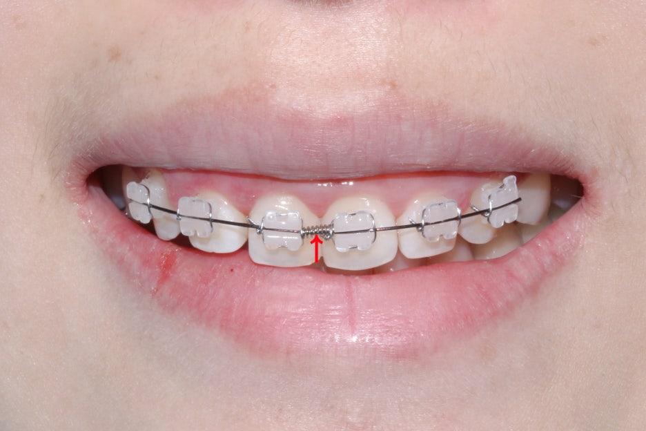 옥니교정 방법! 세라믹교정 Case 관련 이미지 6