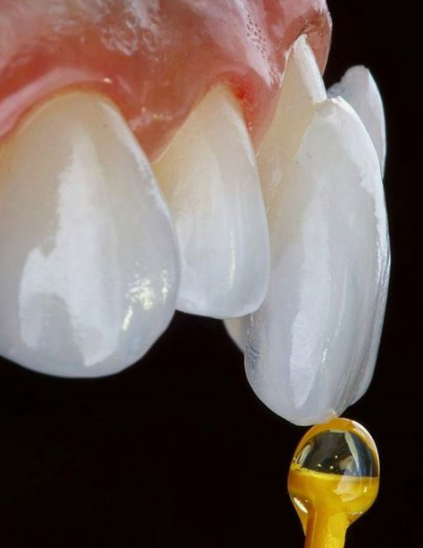 강남라미네이트 무삭제 치아성형 블랙필름 관련 이미지 5