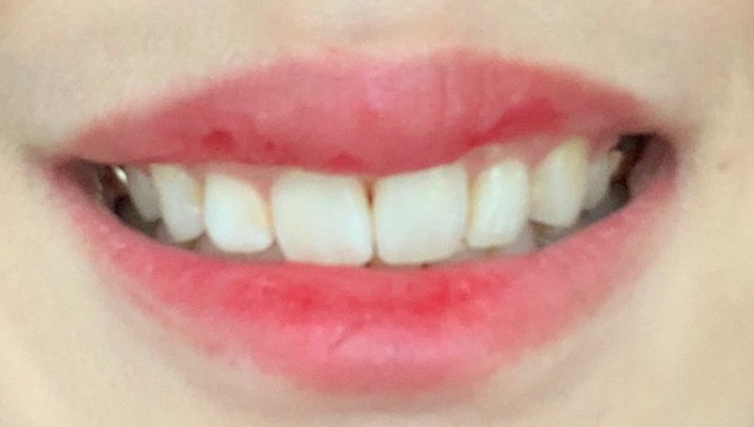 치아변색 개선은 무삭제라미네이트 블랙필름 관련 이미지 2