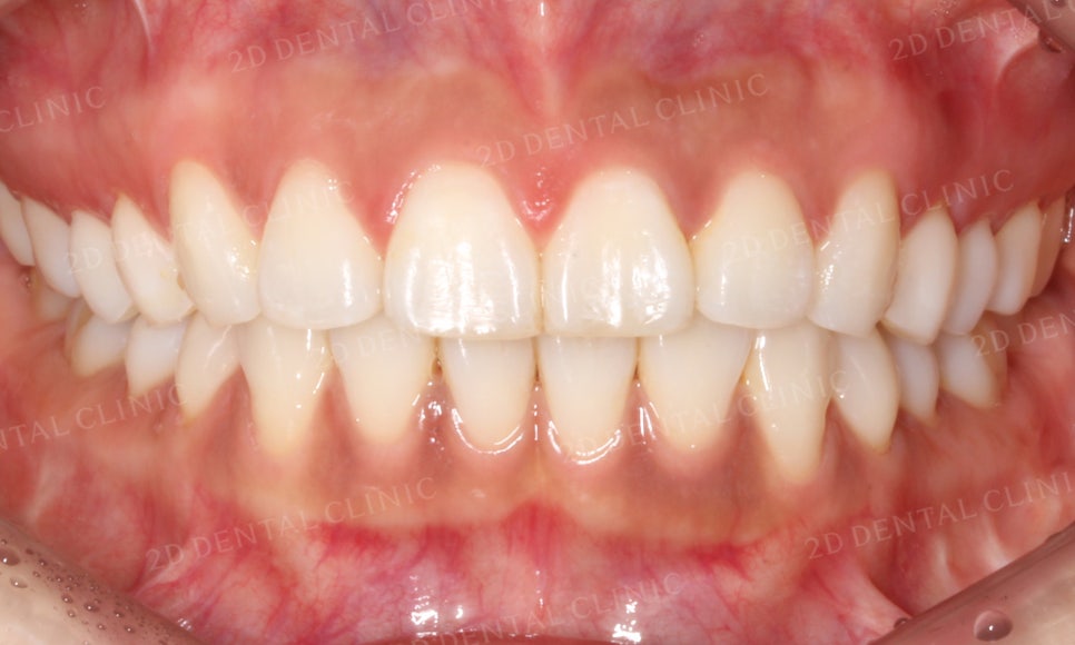 [부분교정] 틀어진 앞니, 부분교정으로 앞니교정하기! by.투디치과(2D치과) 관련 이미지 17