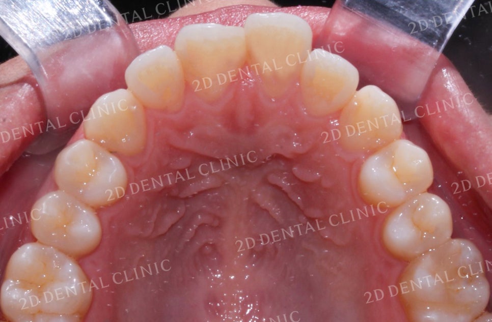 비대칭 앞니, 돌출앞니를 전체 교정으로 교정하고 싶다면!? by.투디치과(2D치과) 관련 이미지 13