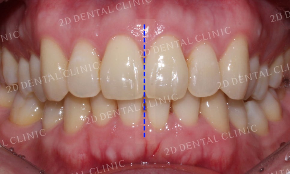 [투디교정] 부정교합 앞니교정을 투디교정으로 고르게! by.투디치과(2D치과) 관련 이미지 14