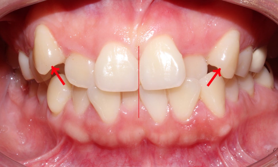 송곳니덧니 교정하는 방법! 관련 이미지 1