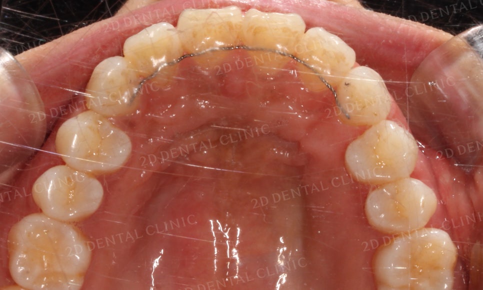[부분교정] 틀어진 앞니, 부분교정으로 앞니교정하기! by.투디치과(2D치과) 관련 이미지 19