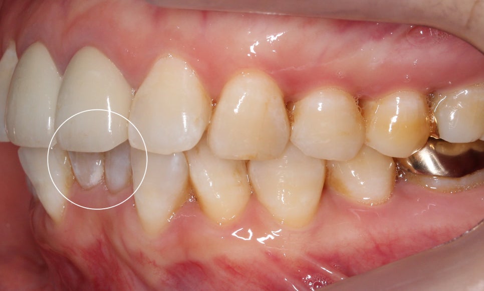 2D교정으로 아랫니 부분교정 빠르게 완성하기! 관련 이미지 2