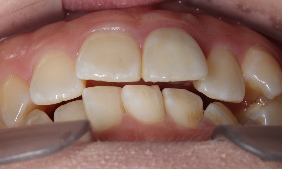 양악교정 송곳니교정 중심으로 관련 이미지 2