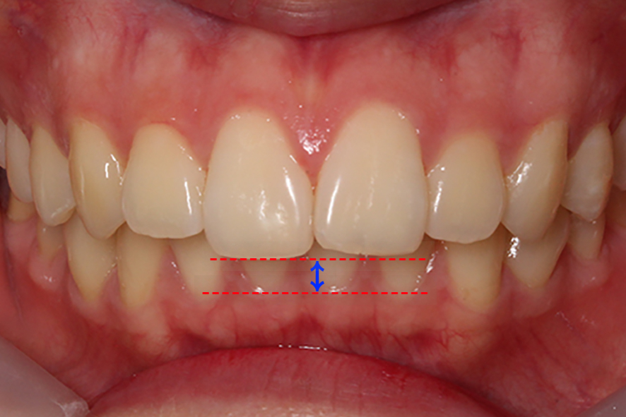 입돌출 데이몬교정 Case1 관련 이미지 1