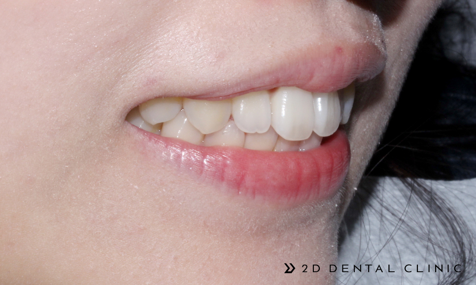 케이스로 확인하는 토끼이빨, 교정전문 2D치과 관련 이미지 5