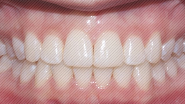 [신논현역치과] 앞니돌출 2D교정으로 개선! 관련 이미지 6