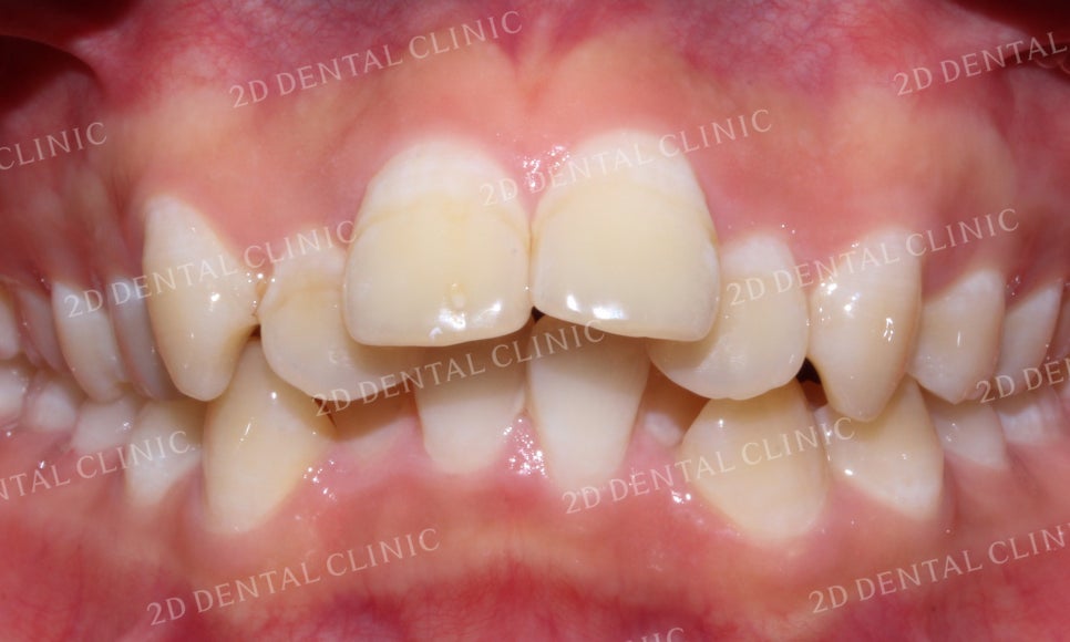 돌출앞니 교정, 튀어나온 입을 넣어보자! by.투디치과(2D치과) 관련 이미지 4