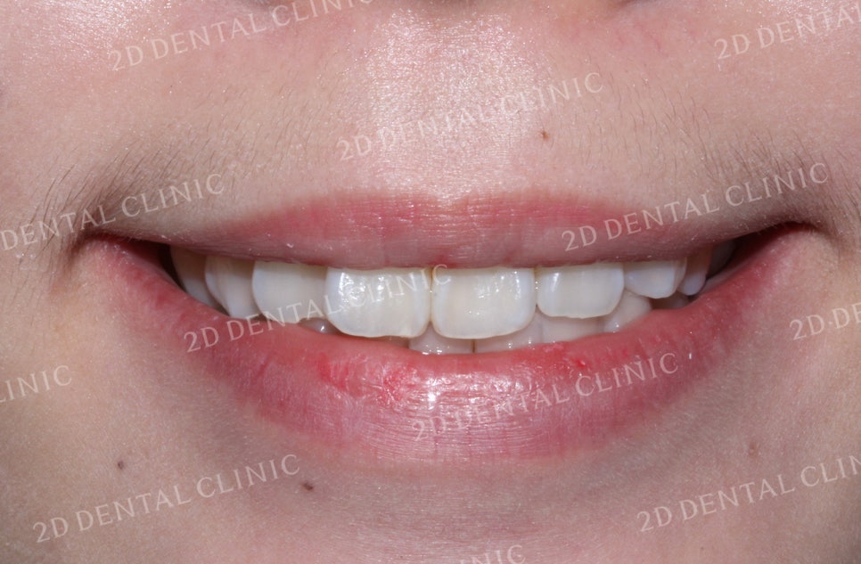 돌출입, 돌출앞니를 부분교정으로 고르게! by.투디치과(2D치과) 관련 이미지 6
