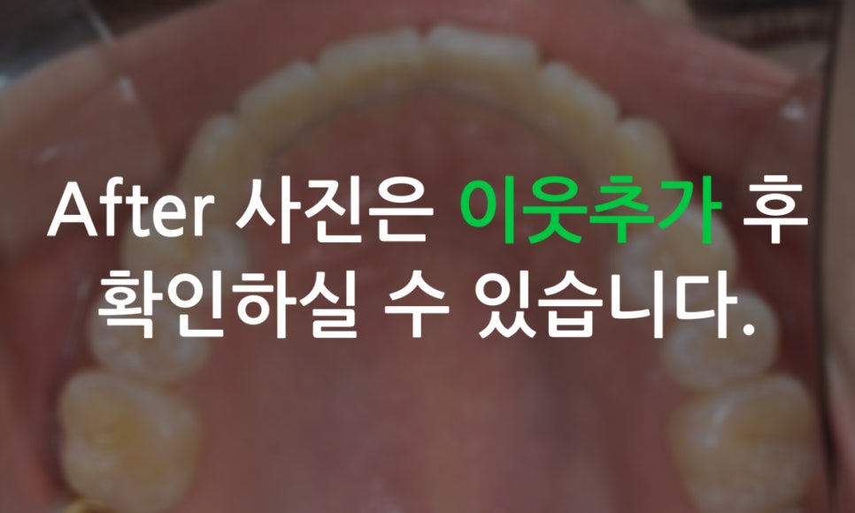 앞니돌출 급속교정 Case feat. 2D교정 관련 이미지 10
