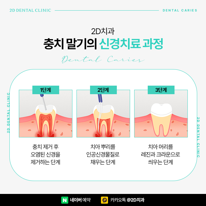 충치치료비용 아끼는 방법, 신논현 충치치료 잘하는 곳 관련 이미지 6