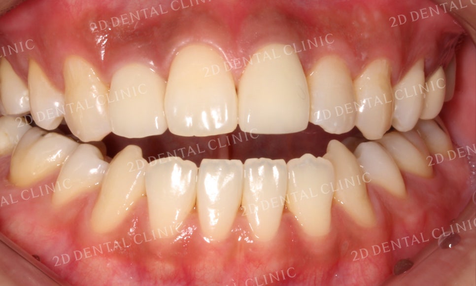 치아변색, 까맣게 변한 변색치를 블링스(Blinx)로 수복하기! by. 투디치과(2D치과) 관련 이미지 11