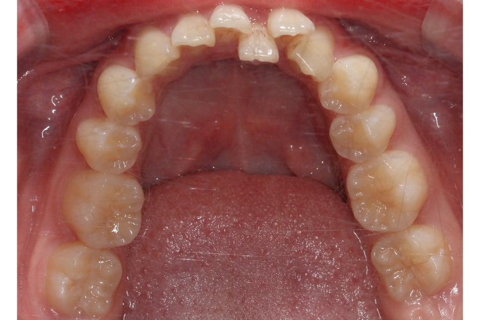 투디치과 송곳니덧니 치료 후기 관련 이미지 7