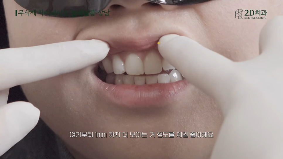 [블랙필름 상담받고 왔어요] #3 앞니가 깨졌어요 관련 이미지 6