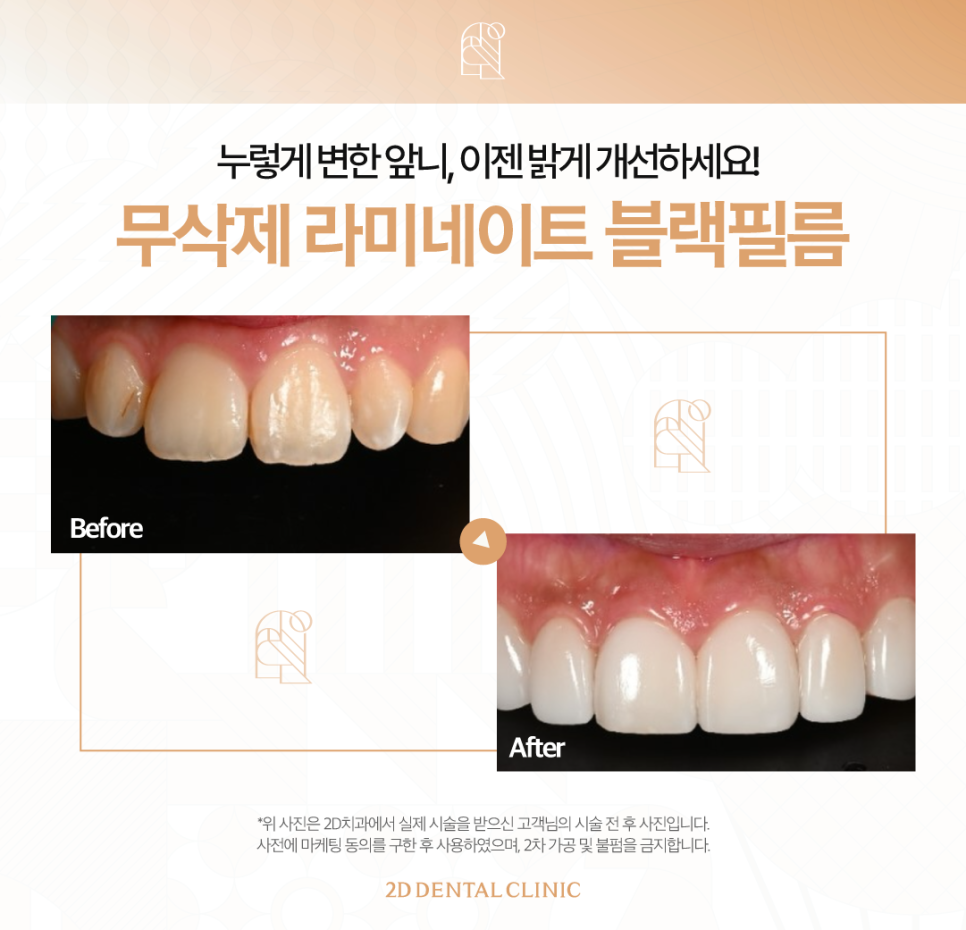 무삭제라미네이트 치아변색 블랙필름으로 화사해진 이 관련 이미지 8