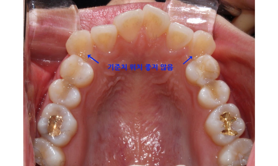 역삼역치과 송곳니덧니 crowding Case 관련 이미지 6