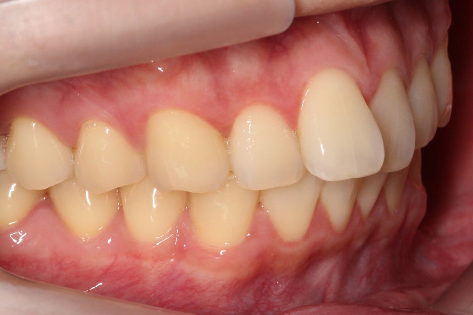 논현동치과 윗니부분교정 후기 관련 이미지 4