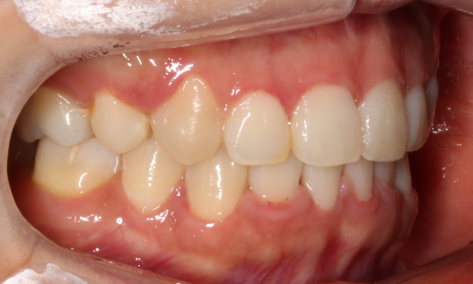 돌출입 탈출기! 덧니 교정도 문제없어! by.투디치과(2D치과) 관련 이미지 11