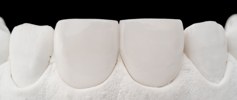 자연스러운 내 치아같은 무삭제라미네이트후기 관련 이미지 3