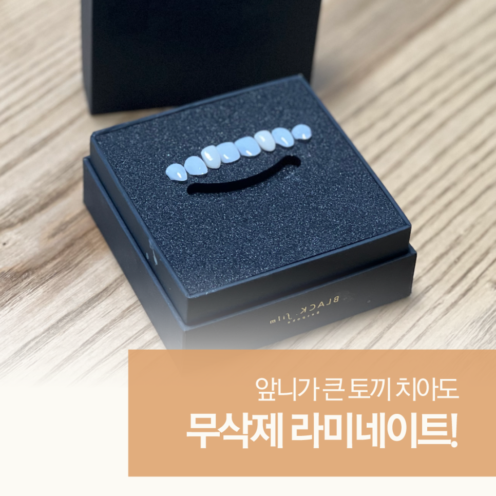 토끼이빨라미네이트 앞니성형으로 단정하고 우아하게 관련 이미지 1